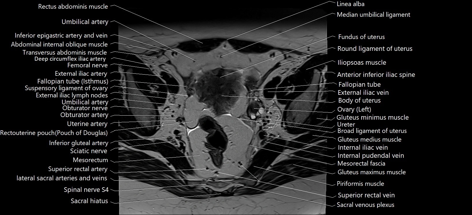 Axial cross sectional anatomy of female pelvis (MRI 3T) image 14.webp